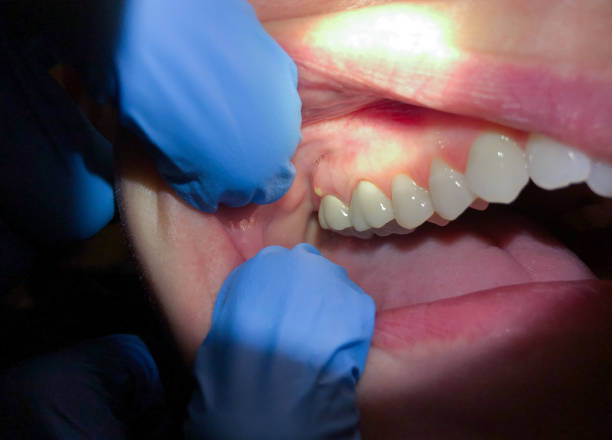 Best Emergency Dental Care for Broken or Chipped Teeth in Lake Wilderness, VA